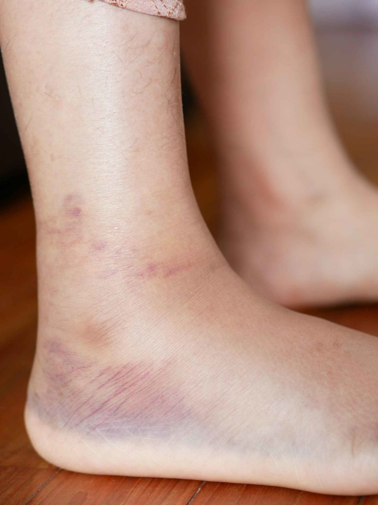 bruises on heels form early diabetes feet